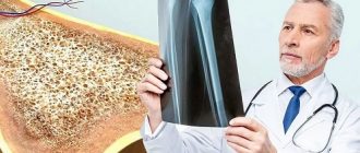 Остеопороз причины болезни и как лечить?