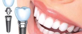 Имплантация зубов — виды, методы и этапы зубной имплантации